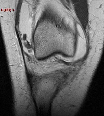 Figure 3 for case Patellar dislocation